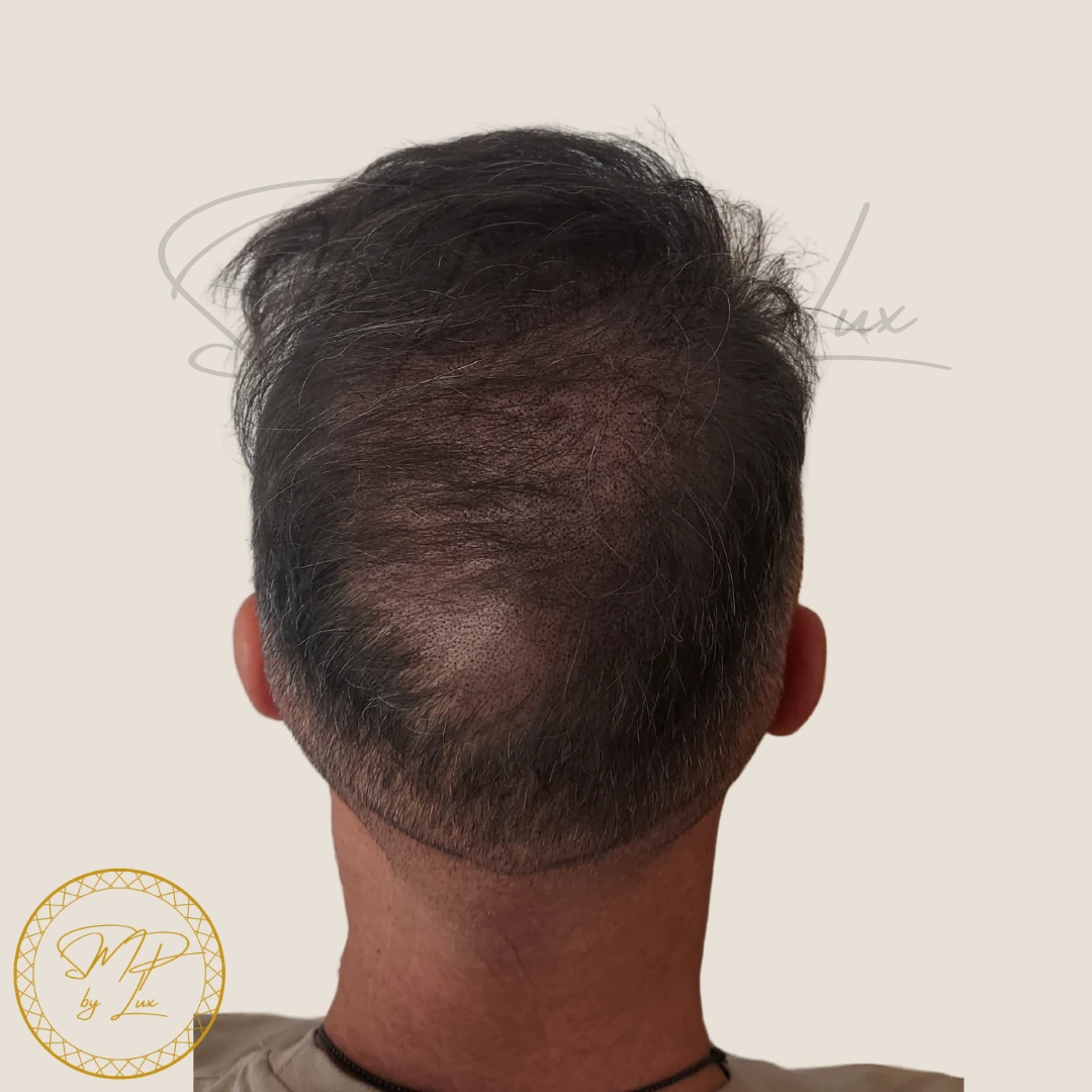 After SMP By Lux crown density enhancement