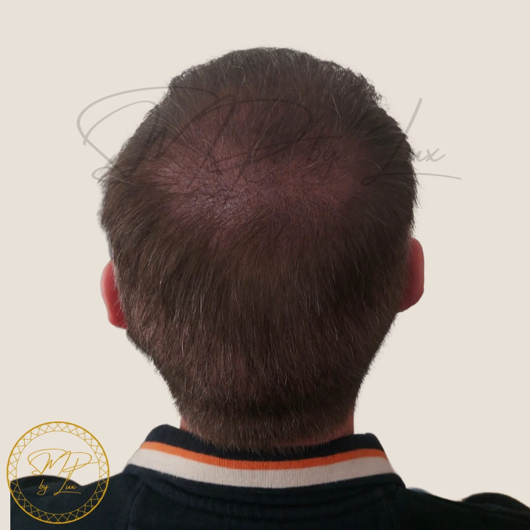 After SMP By Lux soft density restoration