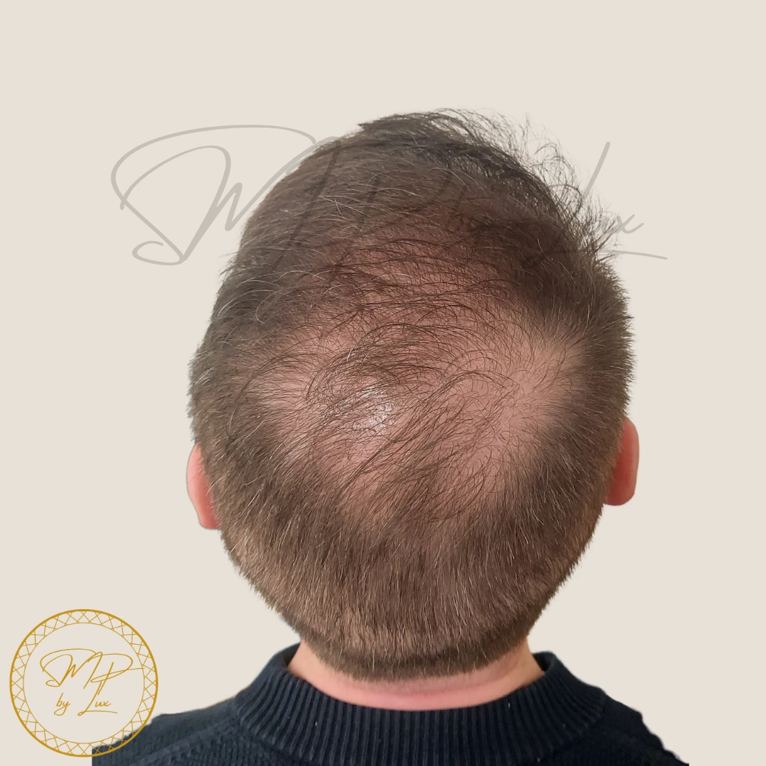 Before SMP By Lux soft density restoration