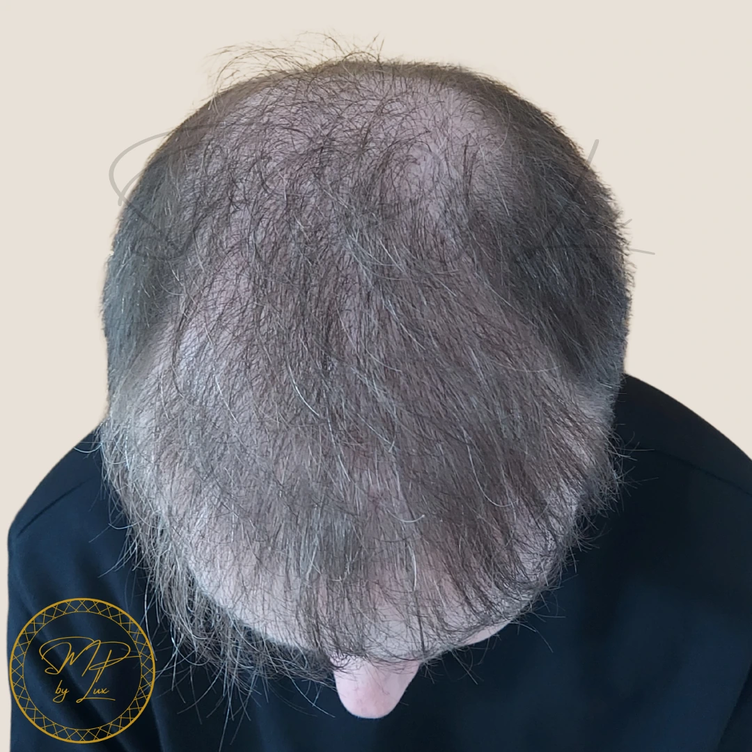 Before SMP By Lux natural scalp coverage
