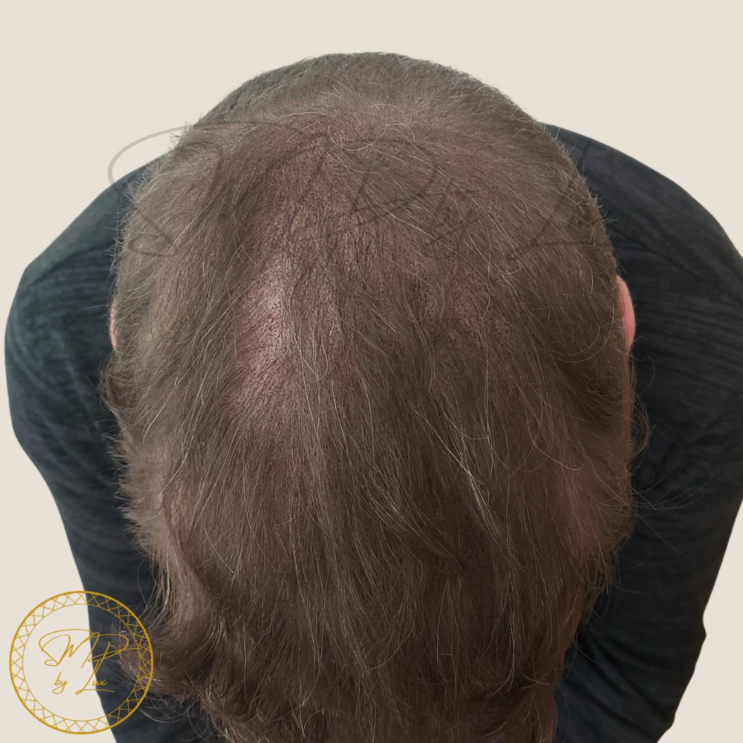 After SMP By Lux thinning coverage treatment on an ivory background