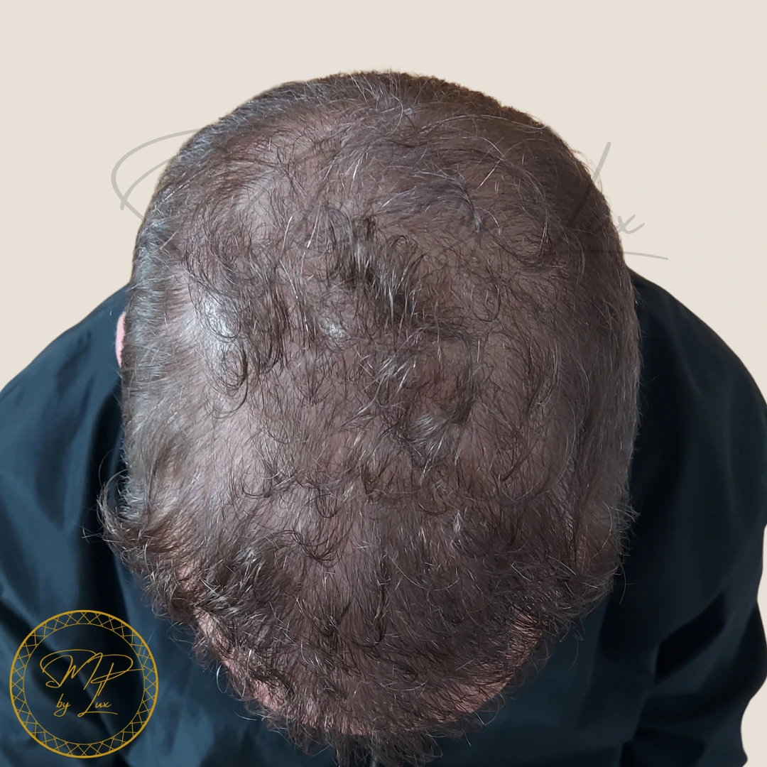 Before SMP By Lux thinning coverage treatment on an ivory background