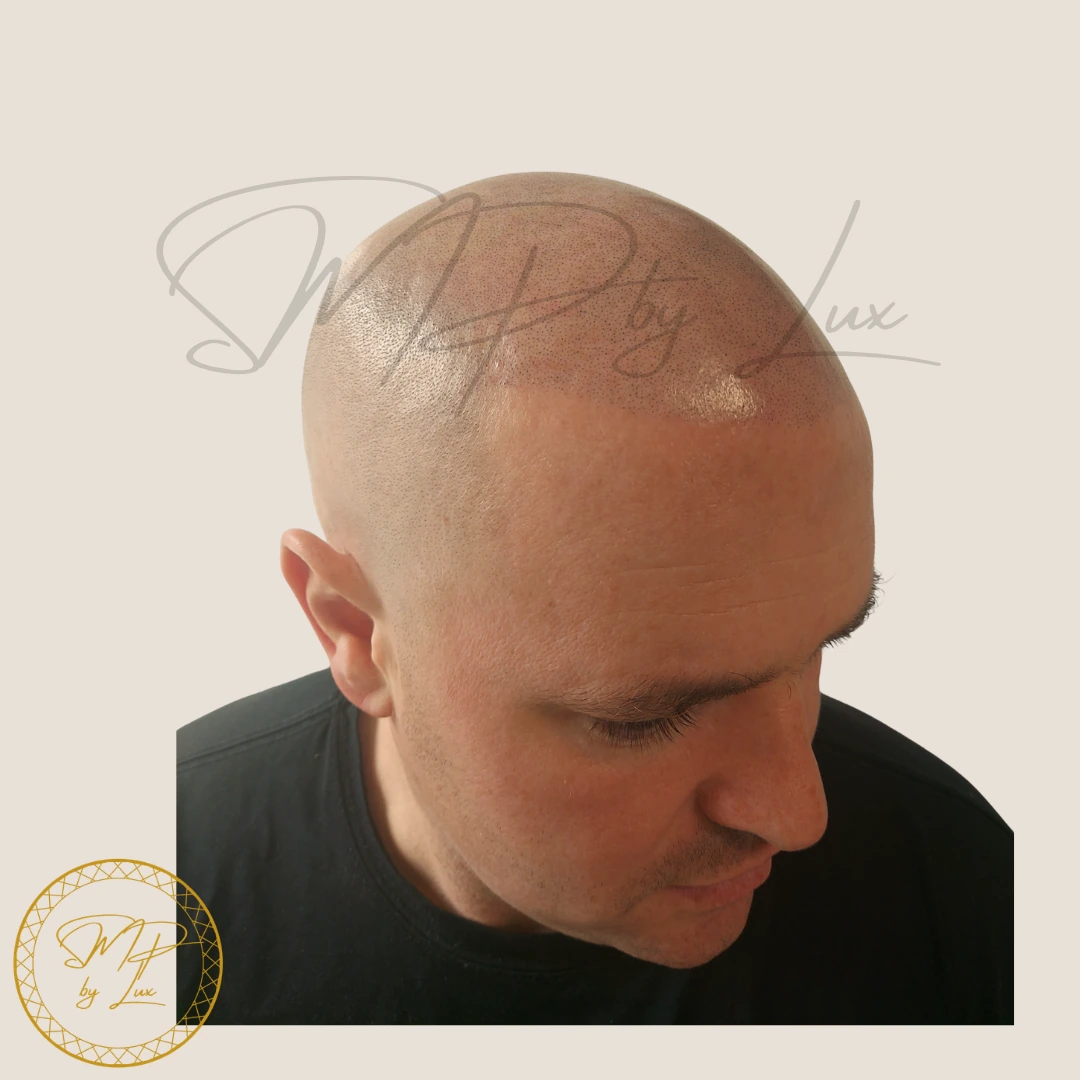 After SMP By Lux soft hairline restoration