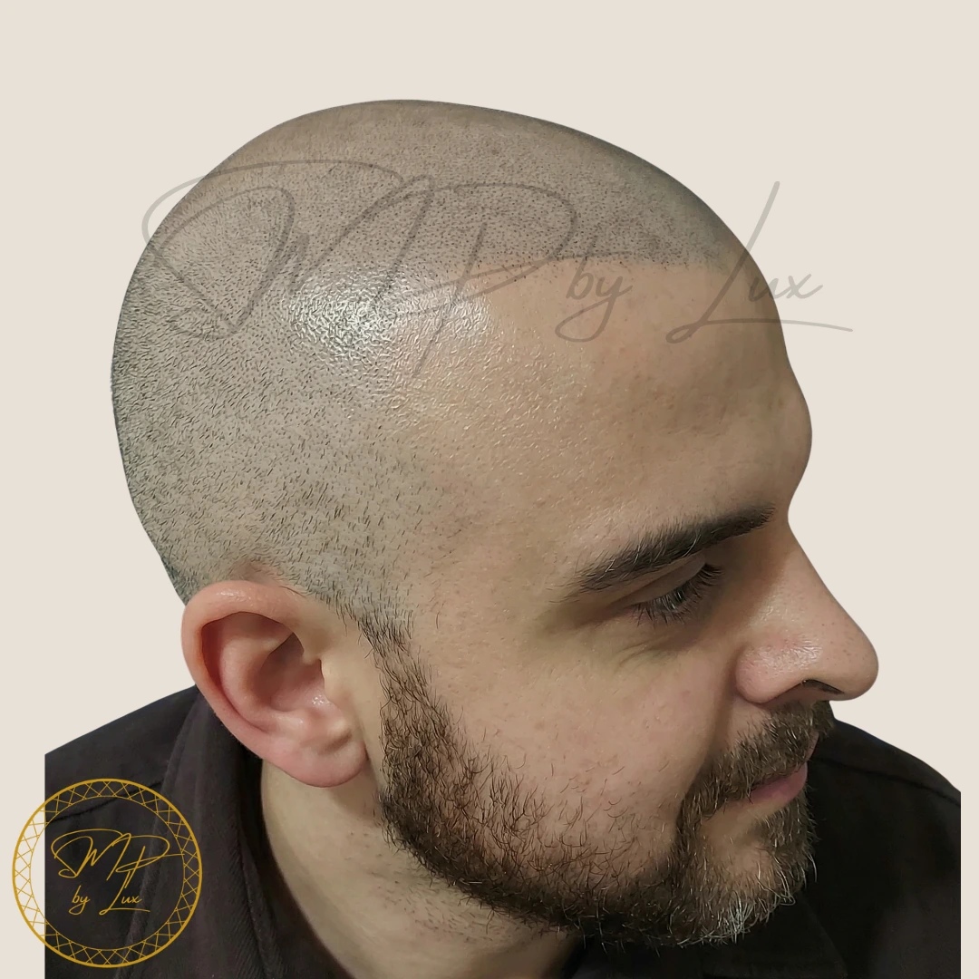 After full-scalp SMP treatment creating a natural shaved look