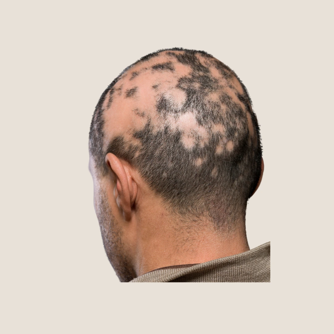 SMP By Lux treatment for alopecia and patchy hair loss