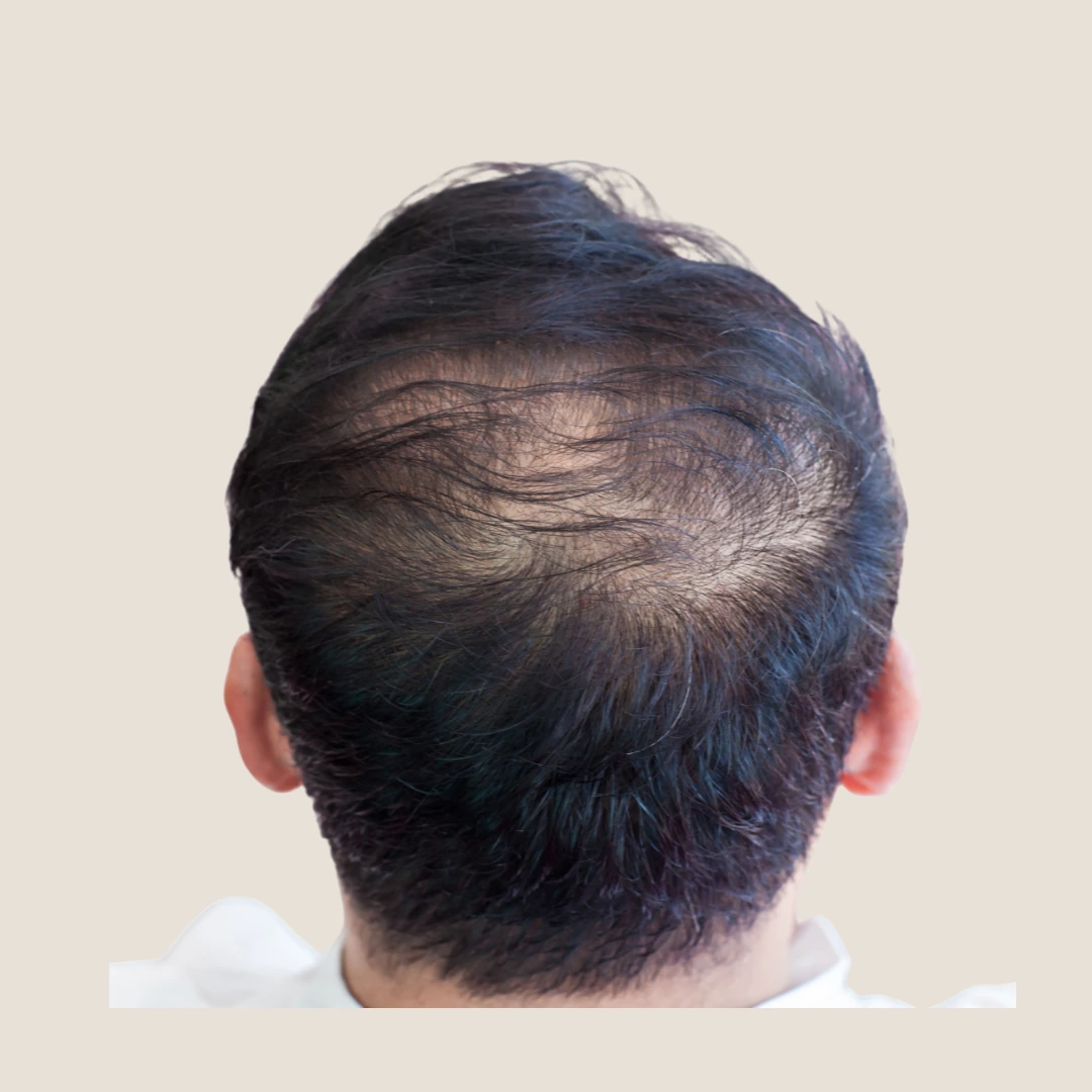 SMP By Lux density treatment for thinning hair