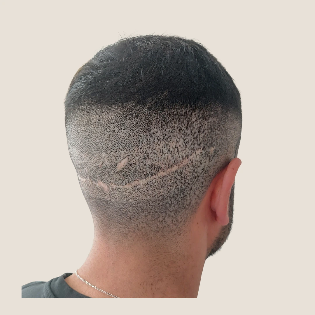 SMP By Lux scalp scar camouflage treatment detail