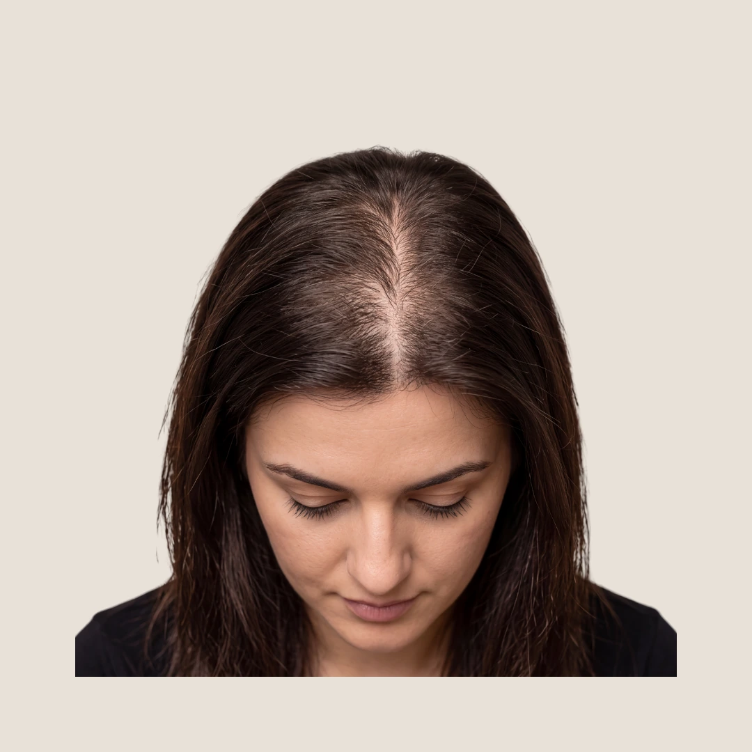SMP By Lux women's density treatment showing the natural hair parting and visible scalp area